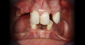 Próximo - Reabilitação Total Superior e Inferior  com Dentes Fixos sobre Implantes