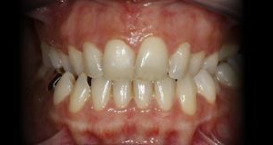 Anterior - Remoção de Pigmentação Gengival com Laser