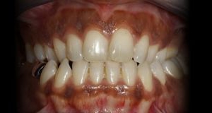 Próximo - Remoção de Pigmentação Gengival com Laser