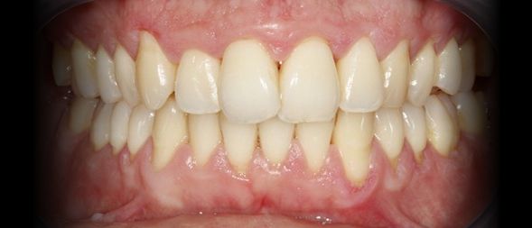 Depois - Tratamento de Gengivite Moderada