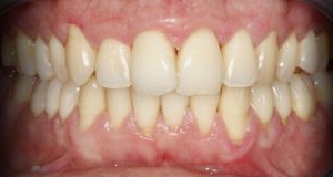 Anterior - Tratamento de Gengivite Moderada