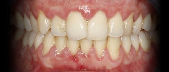 Antes - Tratamento de Gengivite Moderada