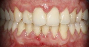 Próximo - Tratamento de Gengivite Moderada