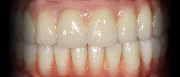 Depois - Reabilitação Oral com Implantes Dentários em ambos maxilares