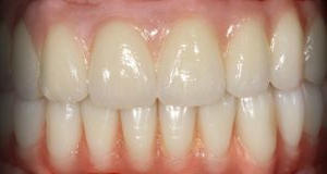 Anterior - Reabilitação Oral com Implantes Dentários em ambos maxilares