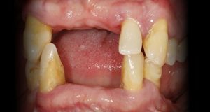 Próximo - Reabilitação Oral com Implantes Dentários em ambos maxilares