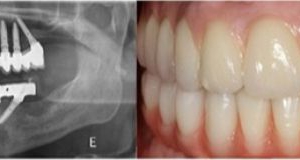 Anterior - Reabilitação Oral com Implantes Dentários em ambos maxilares (visão radiográfica)