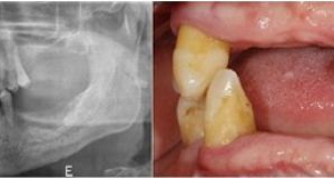 Próximo - Reabilitação Oral com Implantes Dentários em ambos maxilares (visão radiográfica)