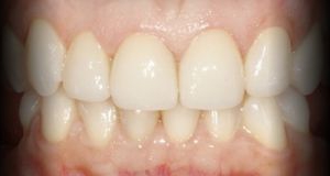 Anterior - Correção da estética dentária com Facetas em Cerâmica - sistema cerec Cad-cam