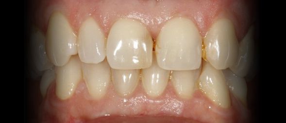 Antes - Correção da estética dentária com Facetas em Cerâmica - sistema cerec Cad-cam
