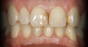 Próximo - Correção da estética dentária com Facetas em Cerâmica - sistema cerec Cad-cam
