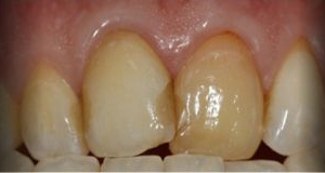 Próximo - Correcção de Coroas com Facetas de Cerâmica