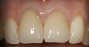 Anterior - Correcção de Coroas com Facetas de Cerâmica