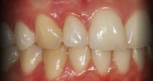 Anterior - Correcção de Dente com Resina Composta