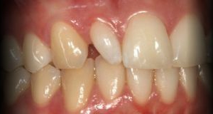 Próximo - Correcção de Dente com Resina Composta