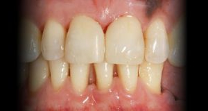 Anterior - Correcção de Diastema entre Centrais com Resina Composta