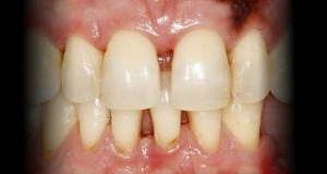Próximo - Correcção de Diastema entre Centrais com Resina Composta