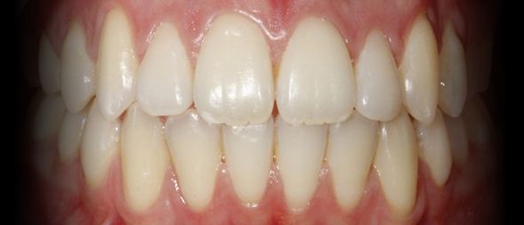 Depois - Correcção Dentária com Ortodontia Fixa
