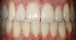 Anterior - Correcção Dentária com Ortodontia Fixa