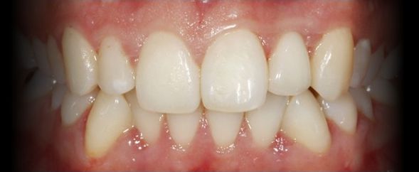 Depois - Reabilitação com Dente Único Fixo sobre Implante