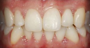 Anterior - Reabilitação com Dente Único Fixo sobre Implante