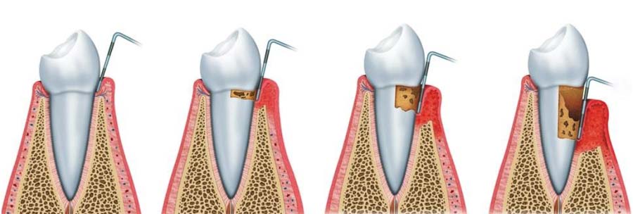 Gengivite e Periodintite: como reconhecer e o que fazer?