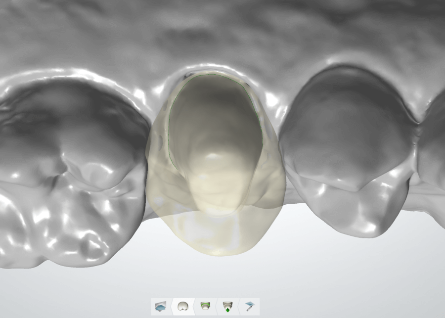 Colocação de Prótese