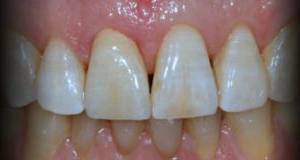 Anterior - Colocação Coroa Cerâmica Pura - Sistema Cerec