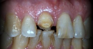 Próximo - Colocação Coroa Cerâmica Pura - Sistema Cerec