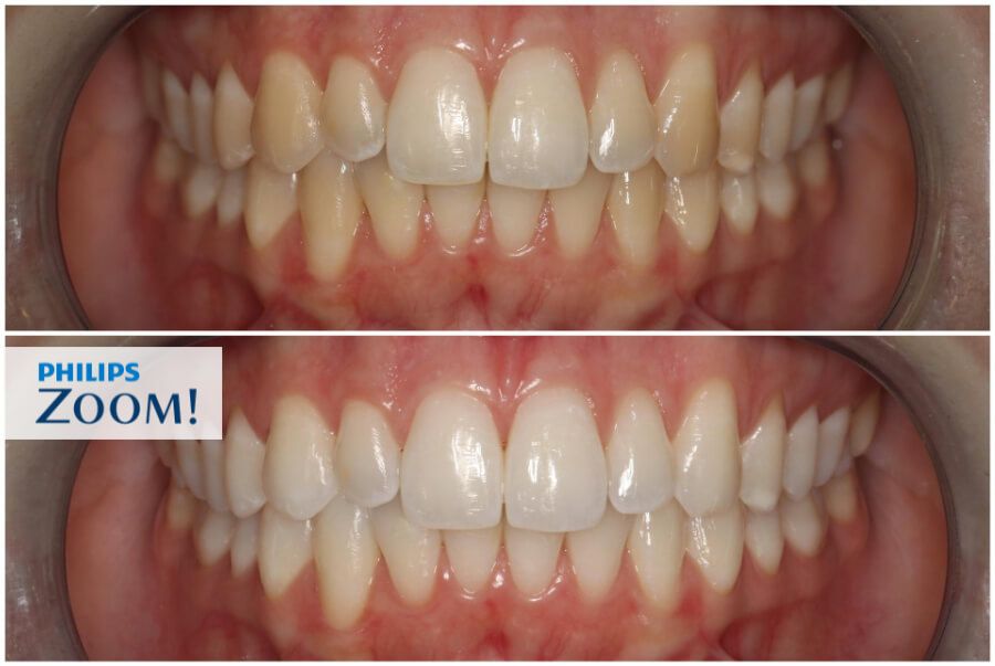 philips zoom antes e depois