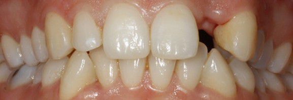 Implantes Dentários - Antes