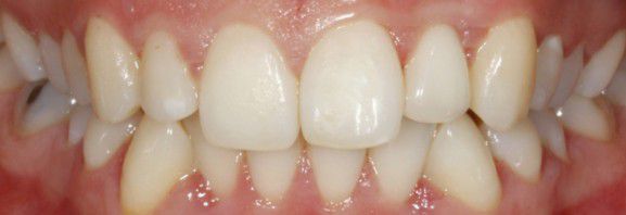 Implantes Dentários - Depois